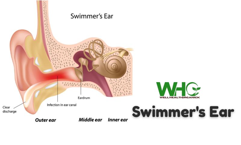 Swimmer’s Ear