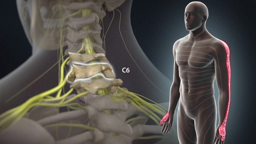 Cervical Laminoforaminotomy: An Expert Guide to Treating Neck and Arm Pain