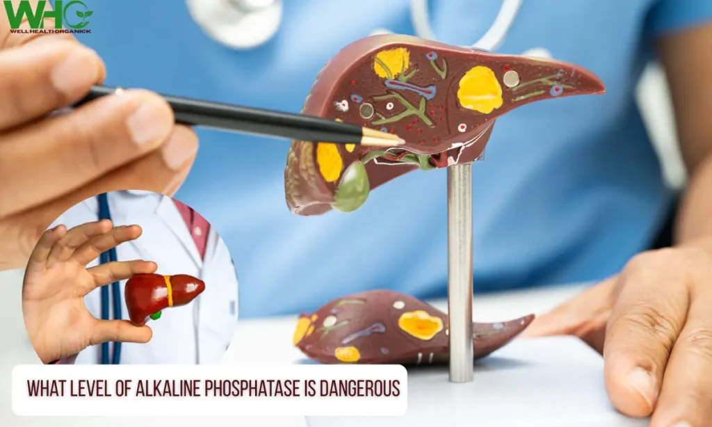 What Level of Alkaline Phosphatase Is Dangerous
